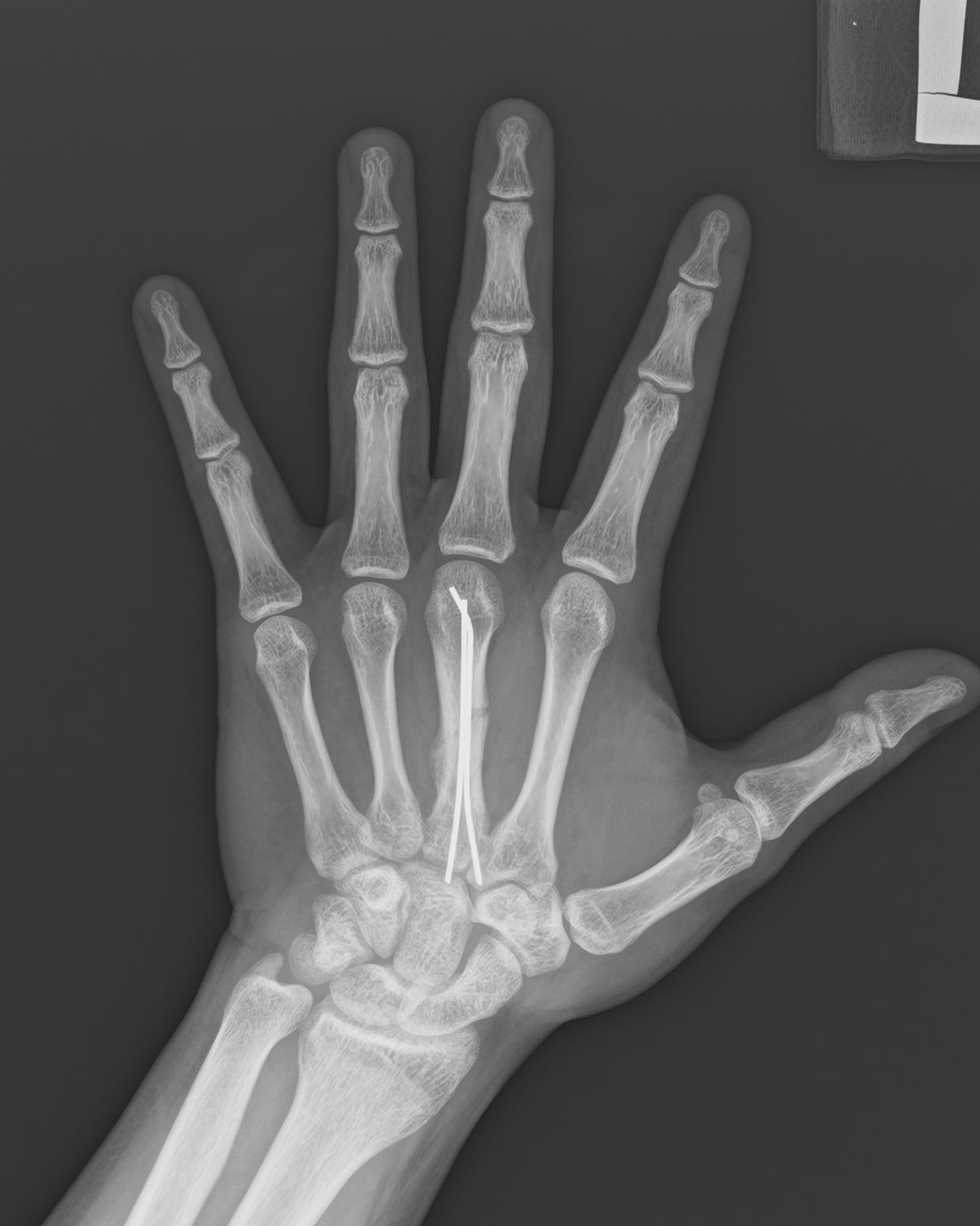 右手第3,4,5掌骨骨折一例 - 病例中心(诊疗助手) - 爱爱医医学网