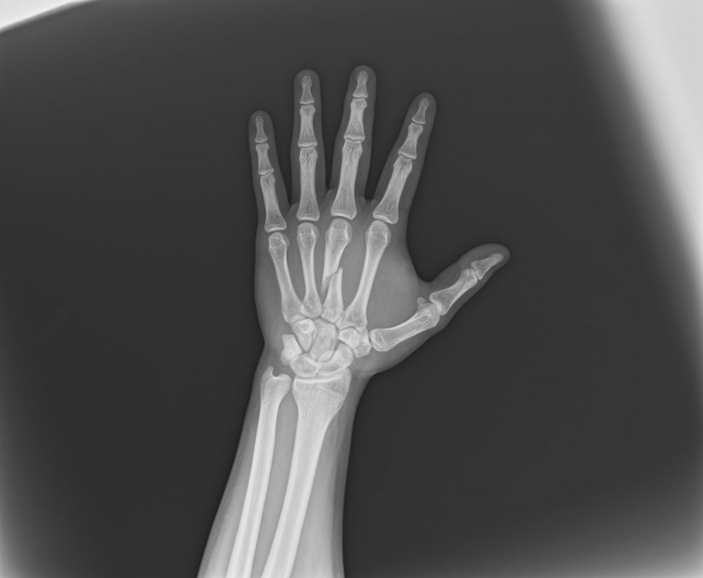 症例集：左手第五中手骨 骨折 太田市の患者さん ｜かわうちはり灸整骨院｜太田市・足利市
